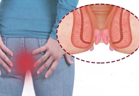 Các dấu hiệu nhận biết bệnh trĩ